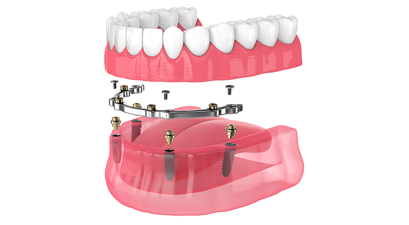 Treatment Banner thumb : Welling Dental